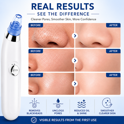 Blackhead Remover With Vacuum Action | 4-in-1 Pore Cleaning Device